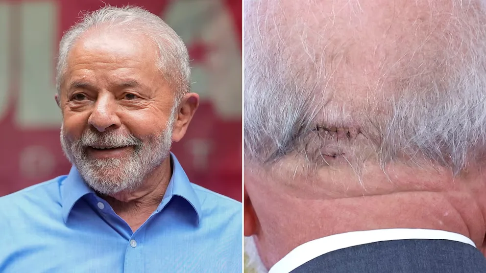 Lula fue operado de urgencia por una hemorragia intracraneal