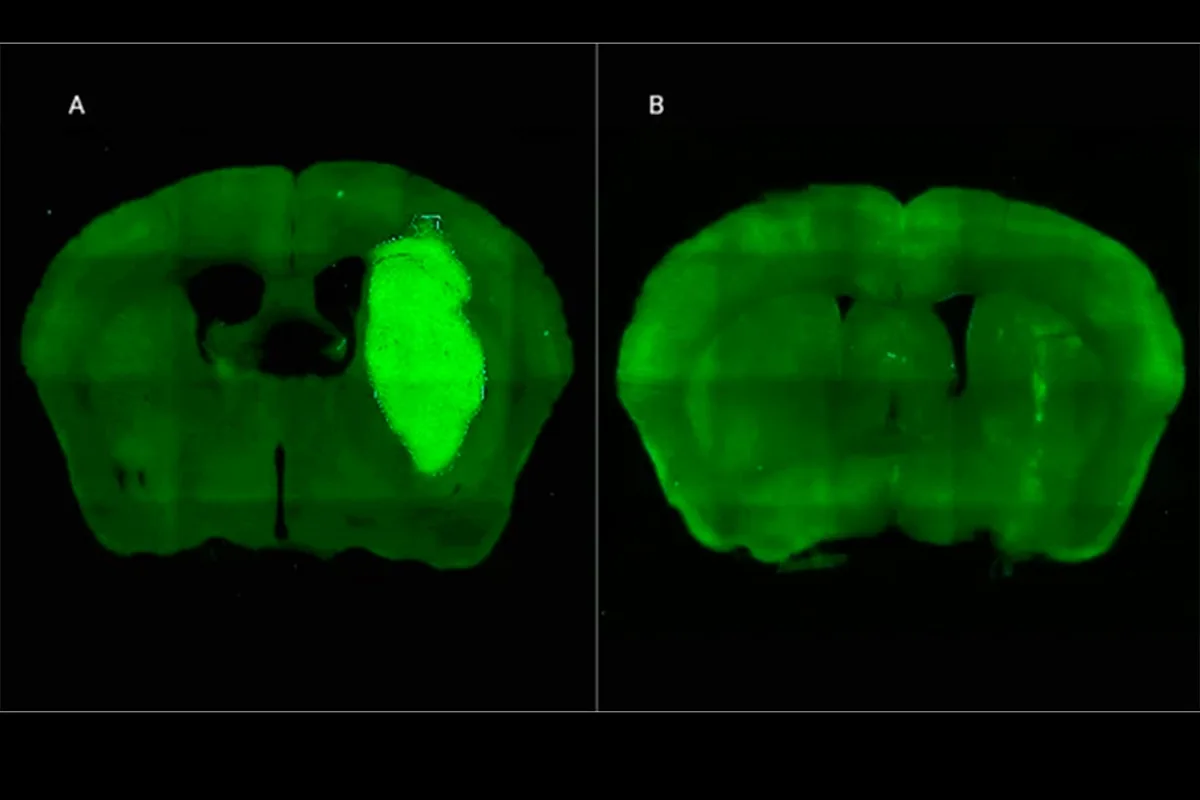 Especialistas del CONICET frenan un tipo de cáncer cerebral con novedosa estrategia